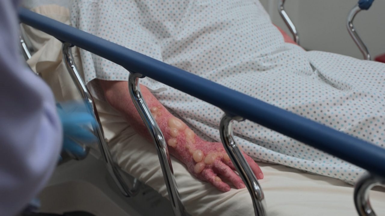 O que é a Queimadura de Margarita? Condição mostrada no episódio 8 da 2ª temporada de The Pitt